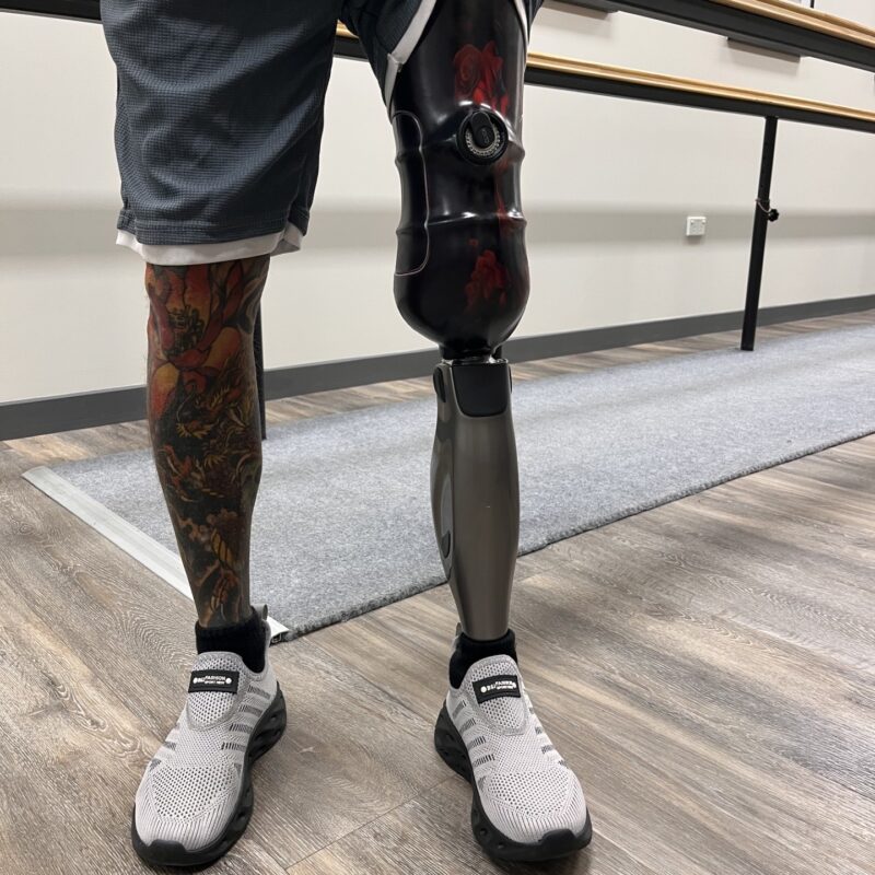 Lower Limb Prosthetics